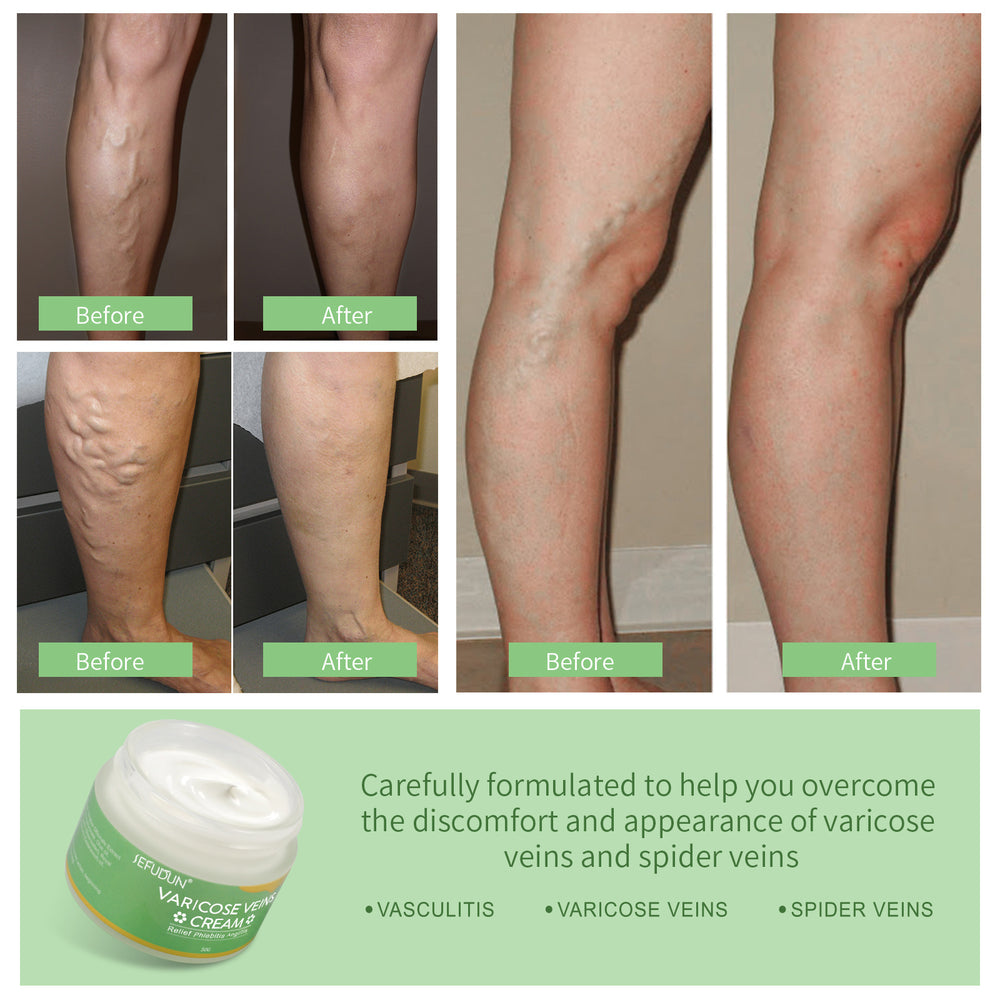 Vein Repair Cream with Sophora japonica and Safflower Extracts